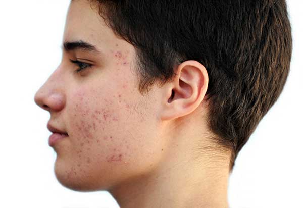 Laser Therapy for Acne Scars