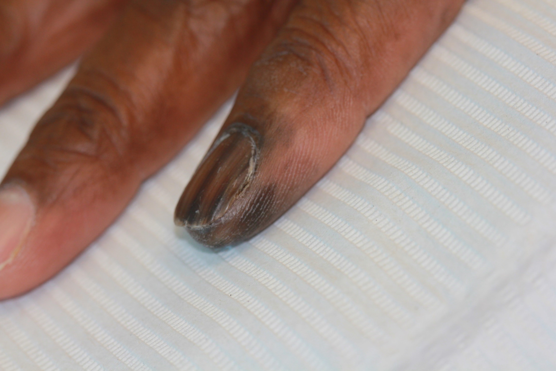 Spotting a Black Line on Nails and What it Signifies - VIMS