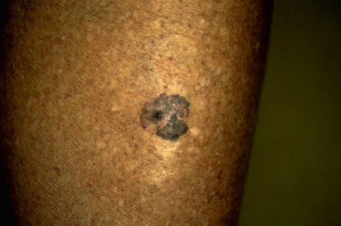 Skin Cancer Photo Gallery