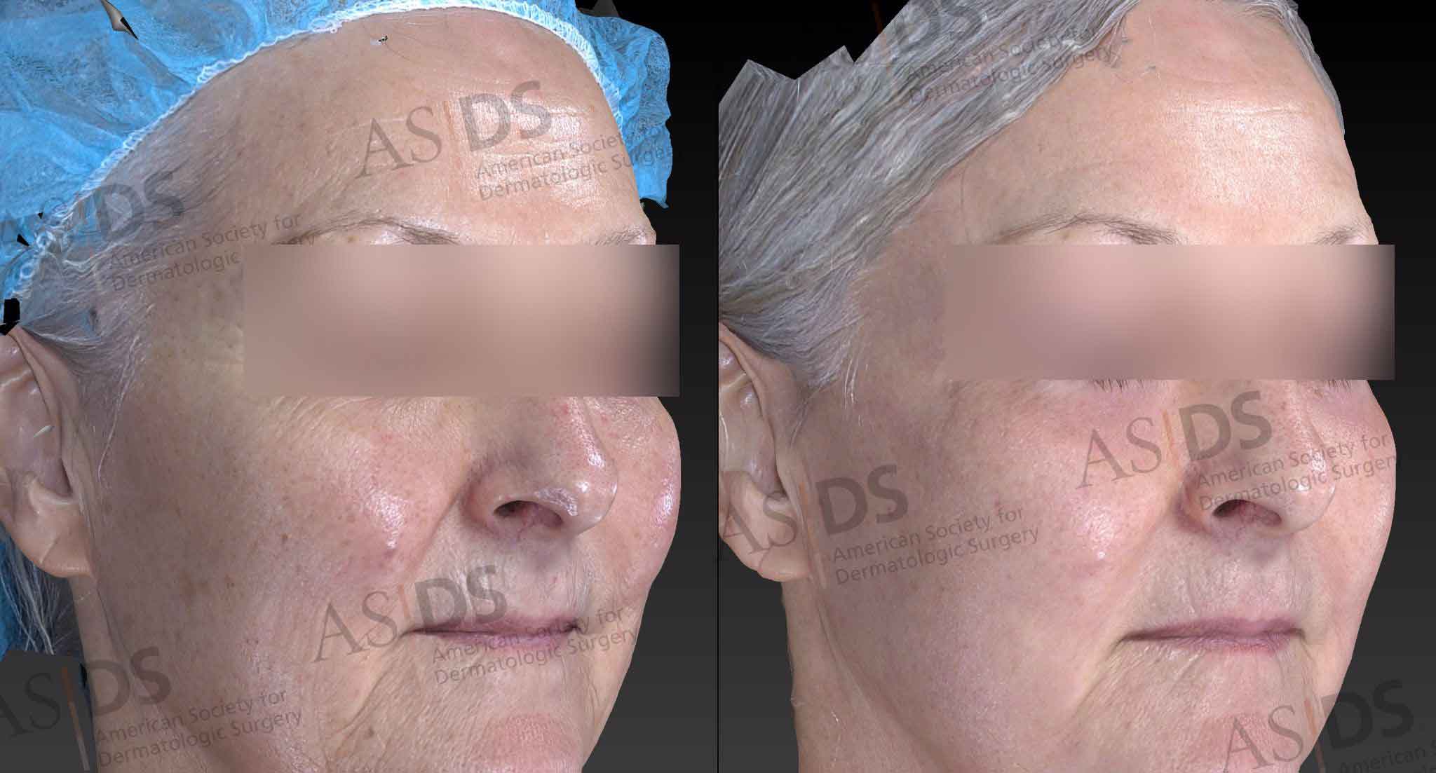 Laser Resurfacing