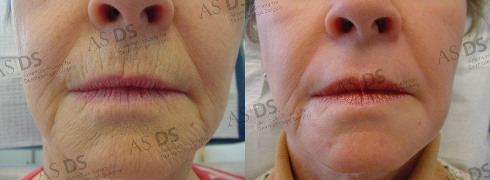 Gabrielle recommends best of Deep chemical peel facial chemical peel facial Deep
