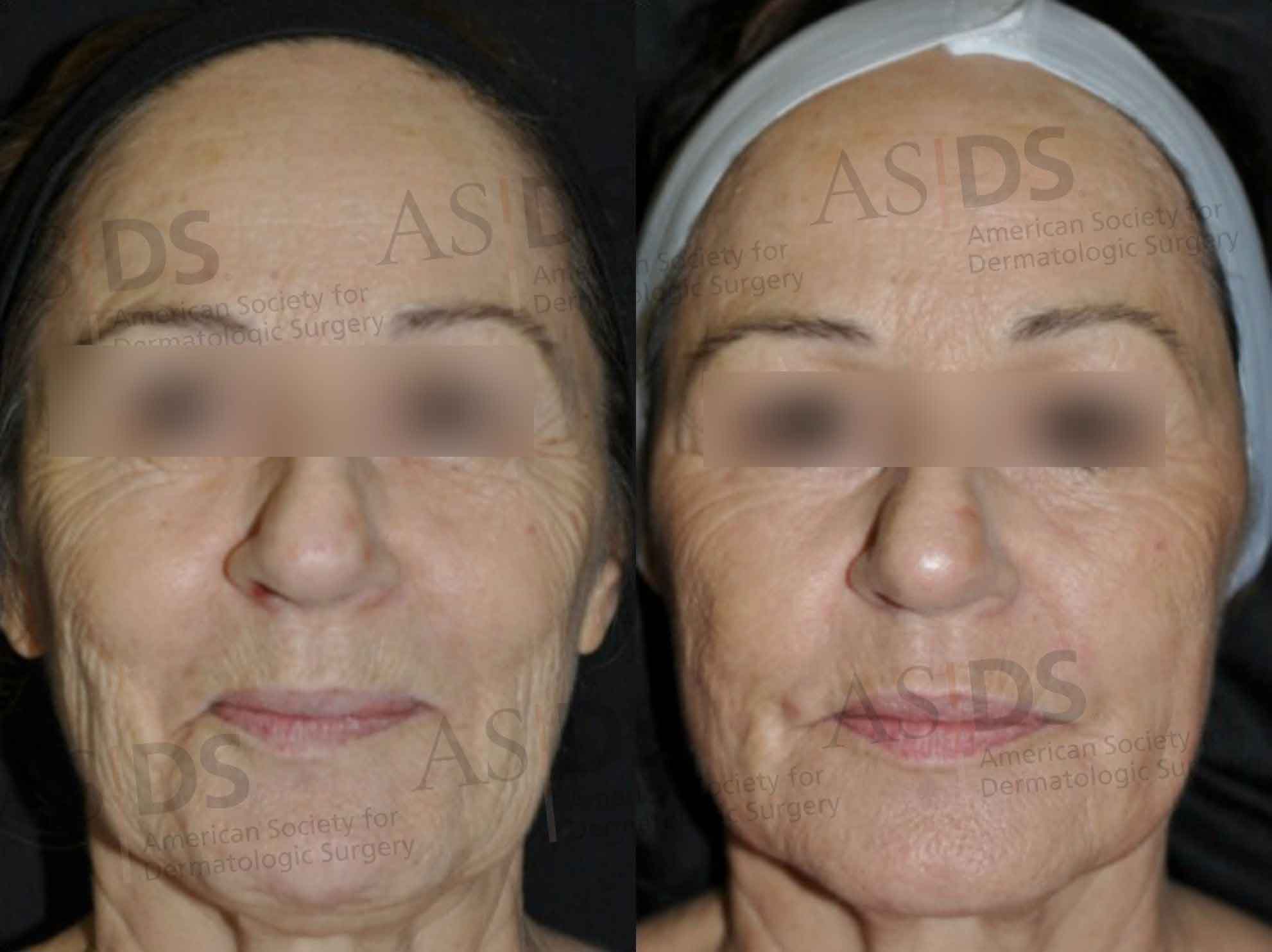 Laser Resurfacing