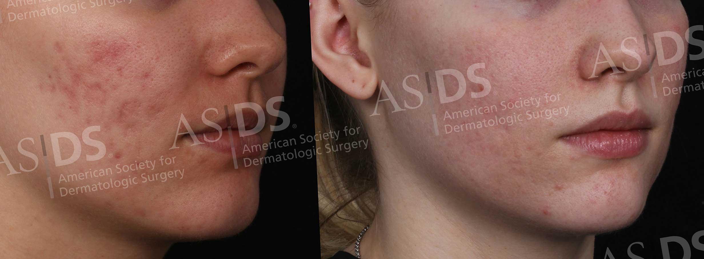 Laser Treatment For Acne Scars Before And After