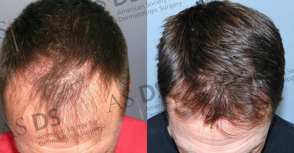 Female Hair Transplant in Hyderabad  View Cost  ReDefine Clinic