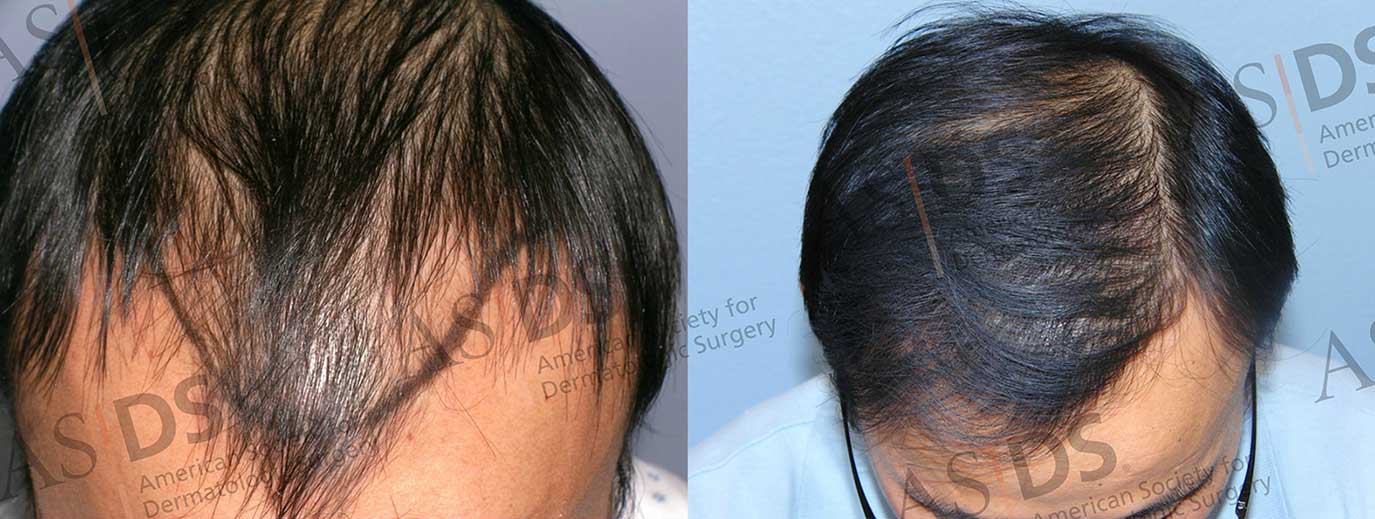 Hair Transplant Sideveffects - Side effects of hair transplant &  consultation, 2021